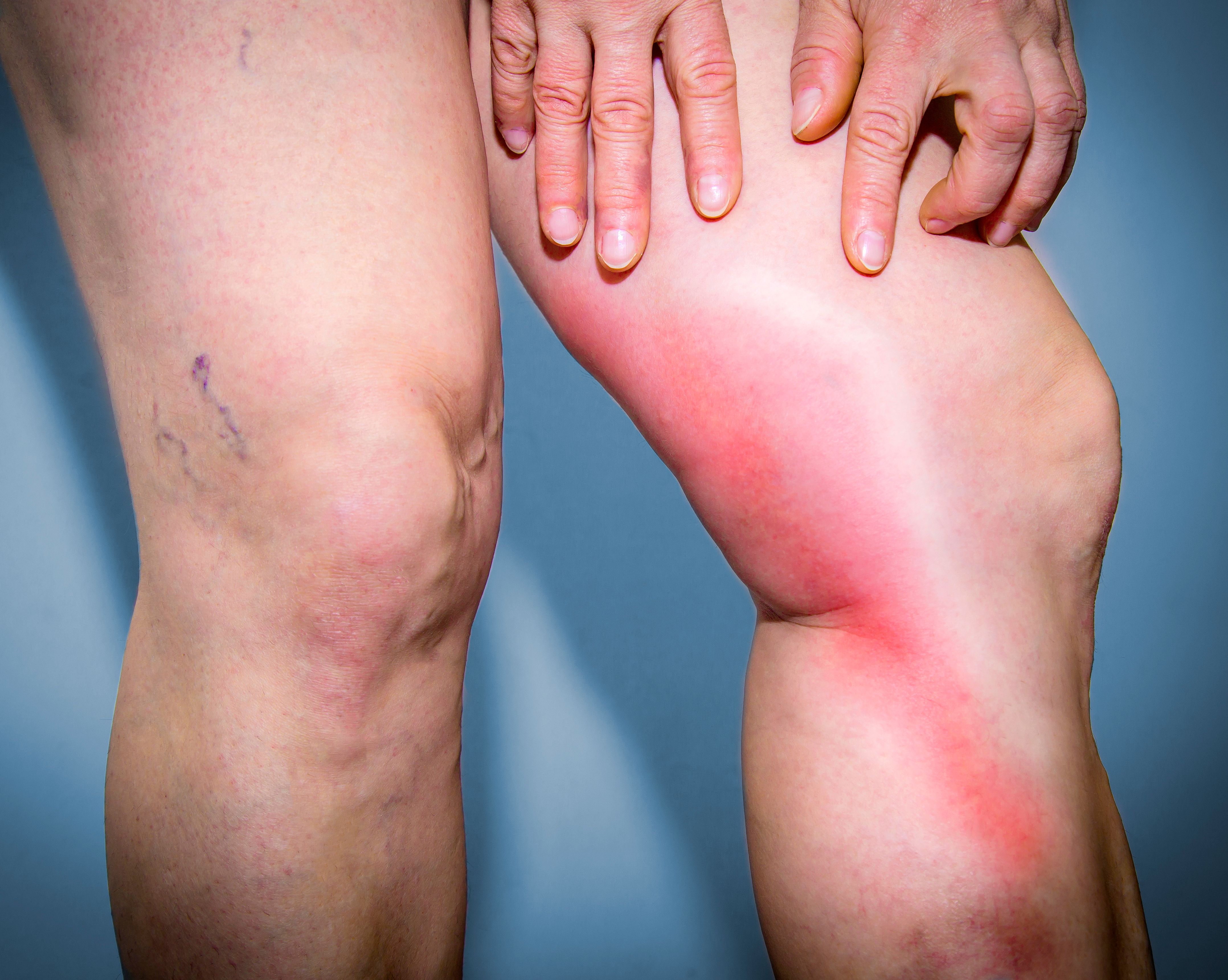 tromboflebite