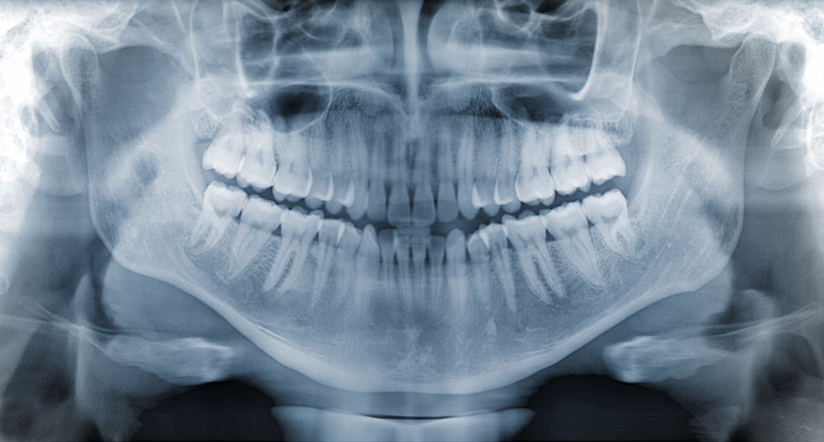jawbone x-ray