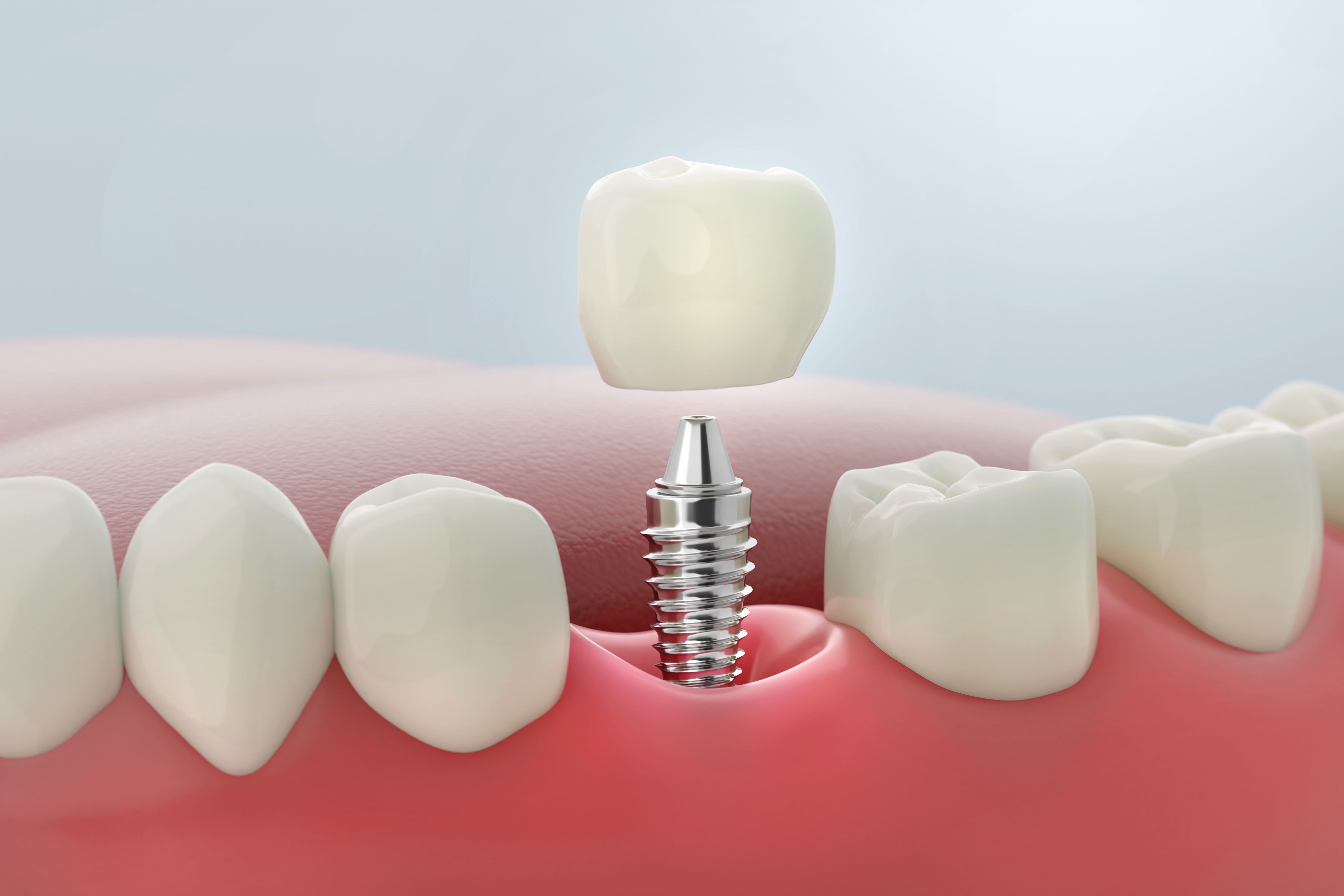 dental implant