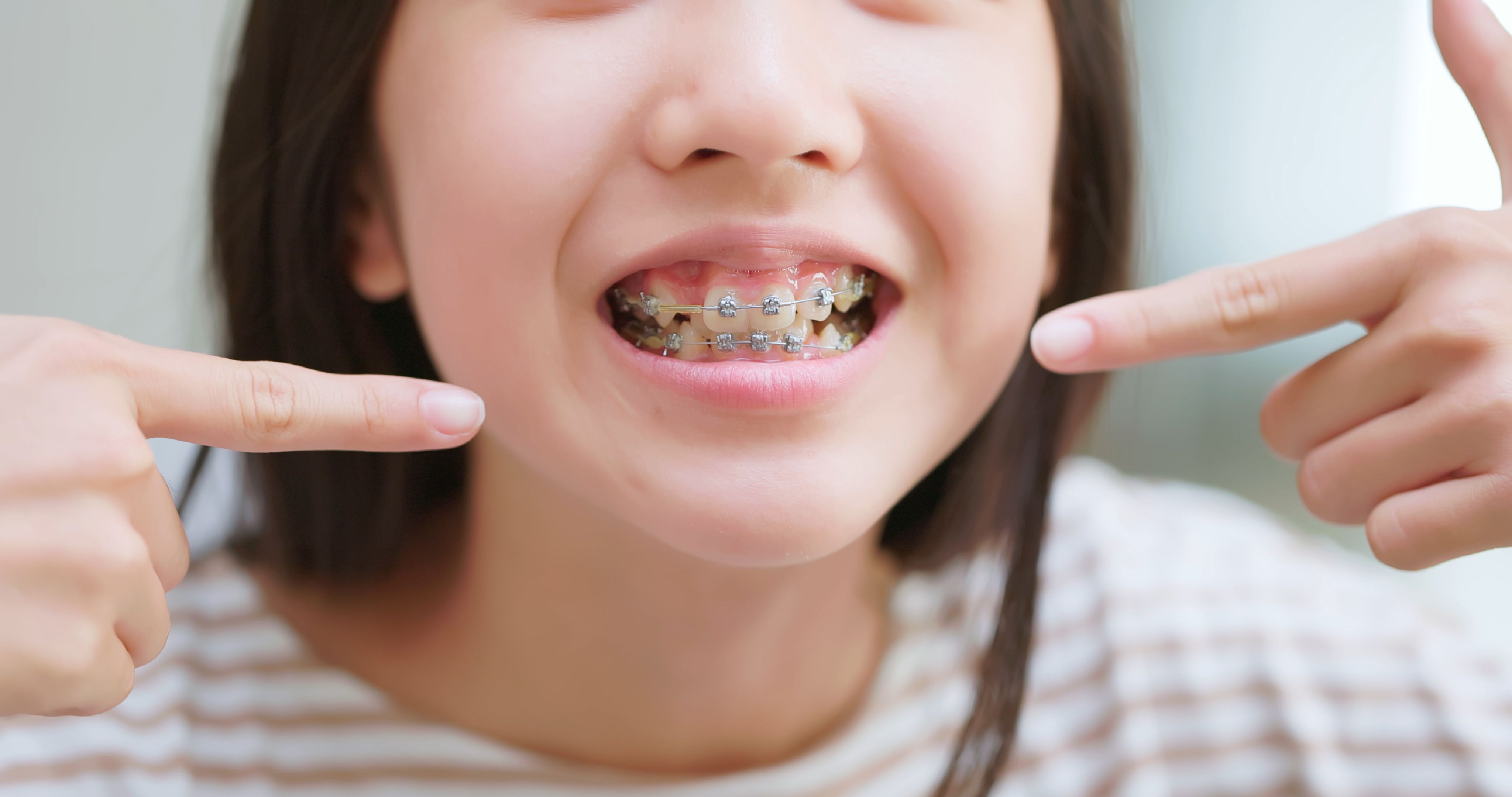 maintaining braces