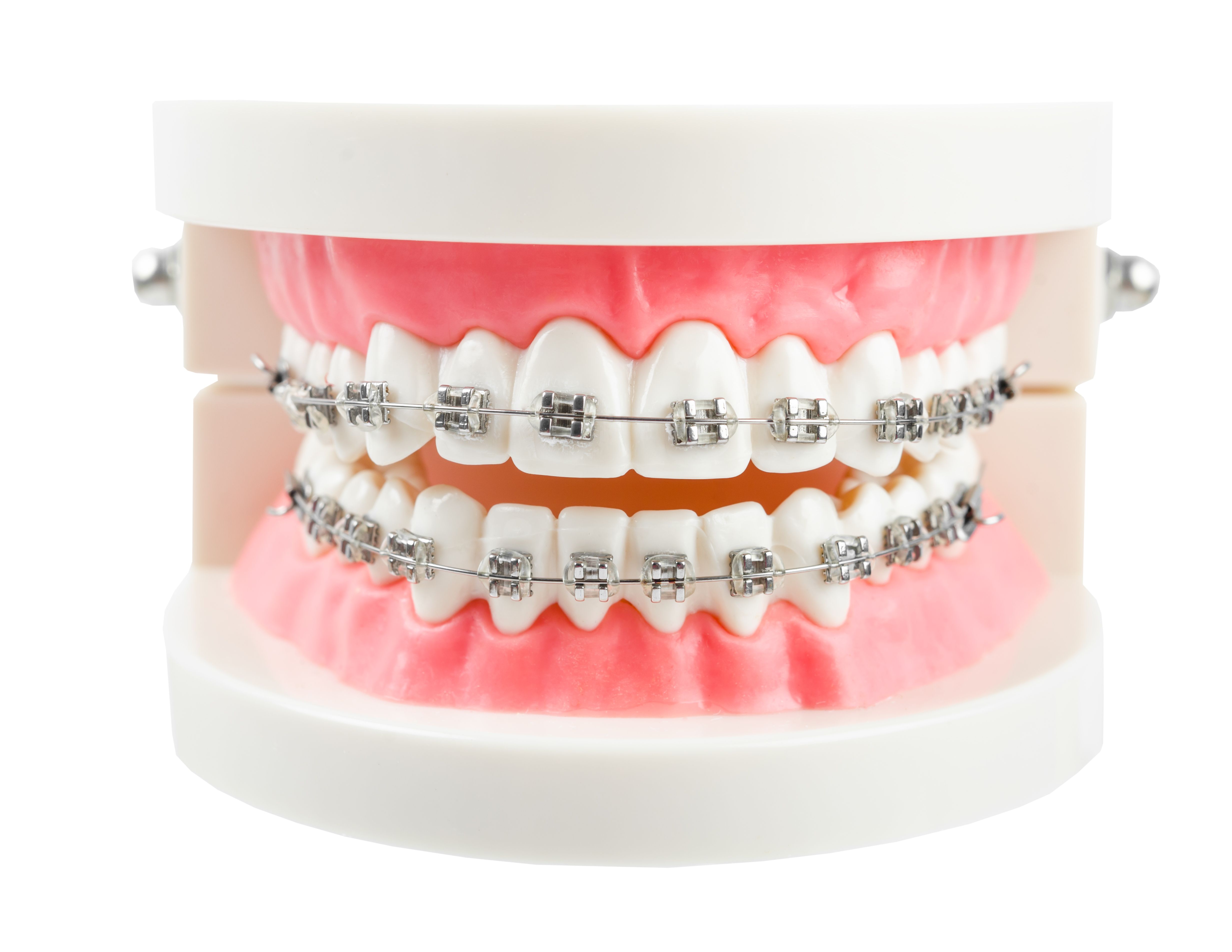 traditional braces