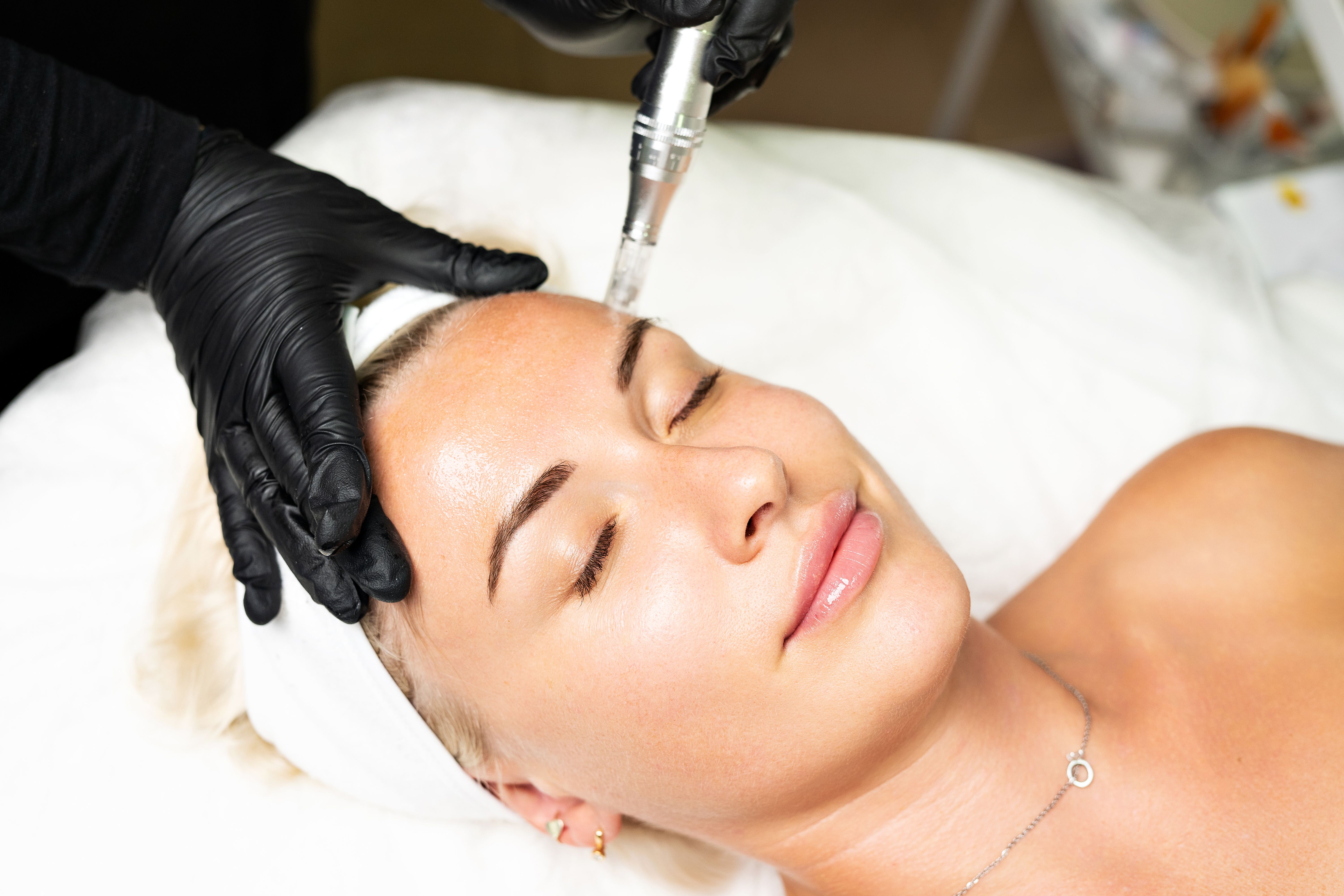 microneedling recovery