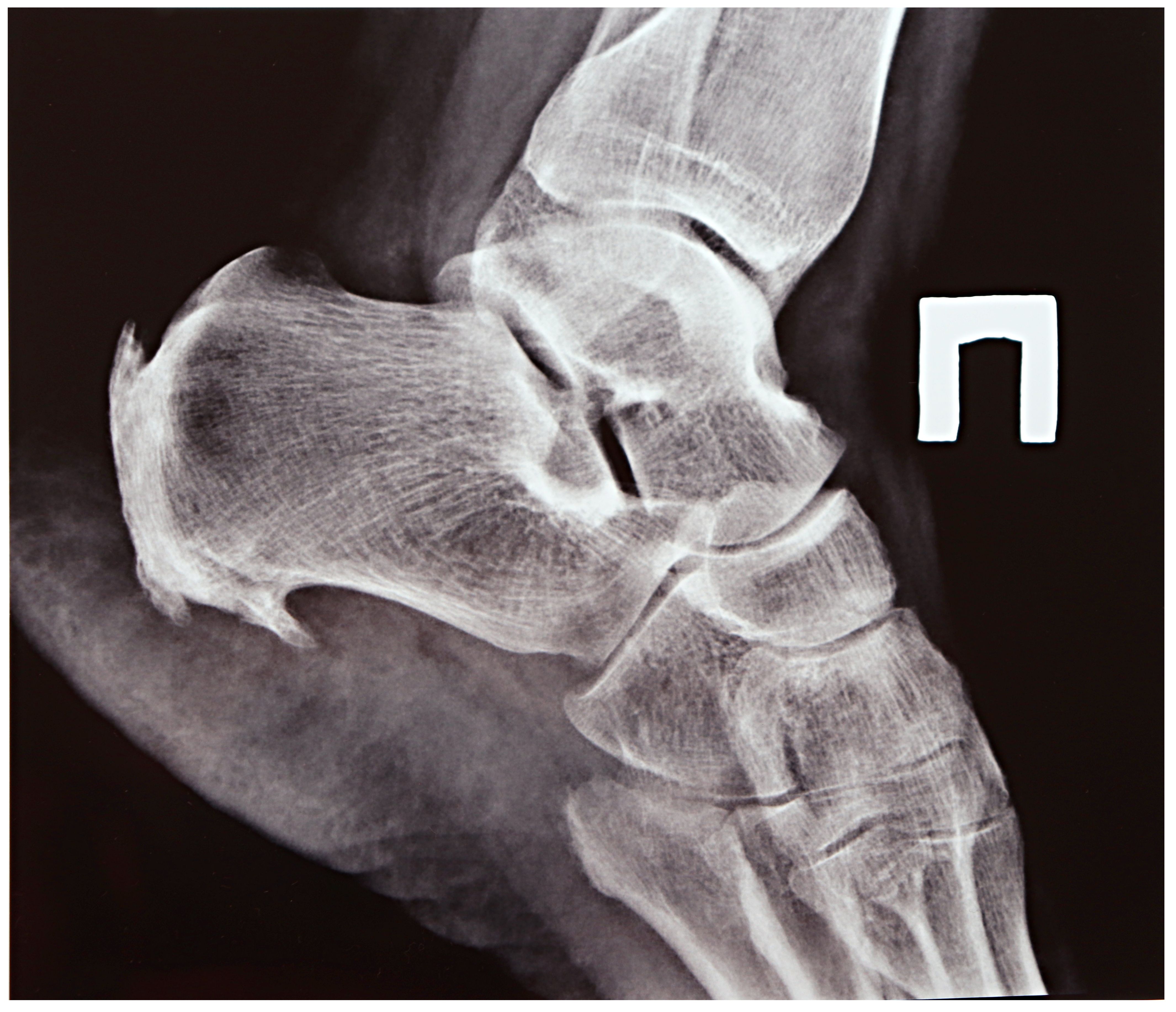 heel spur X-ray