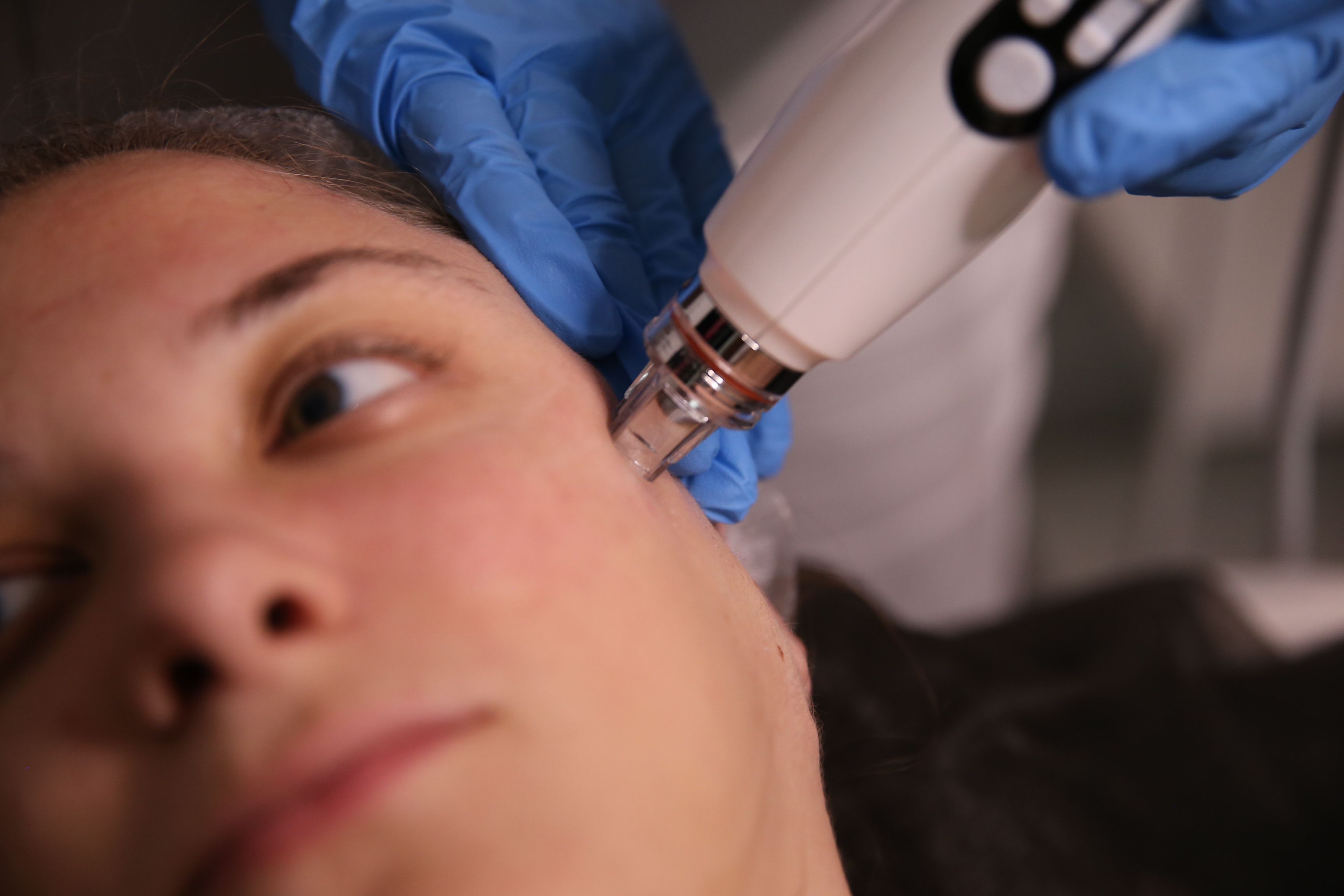 microdermabrasion procedure