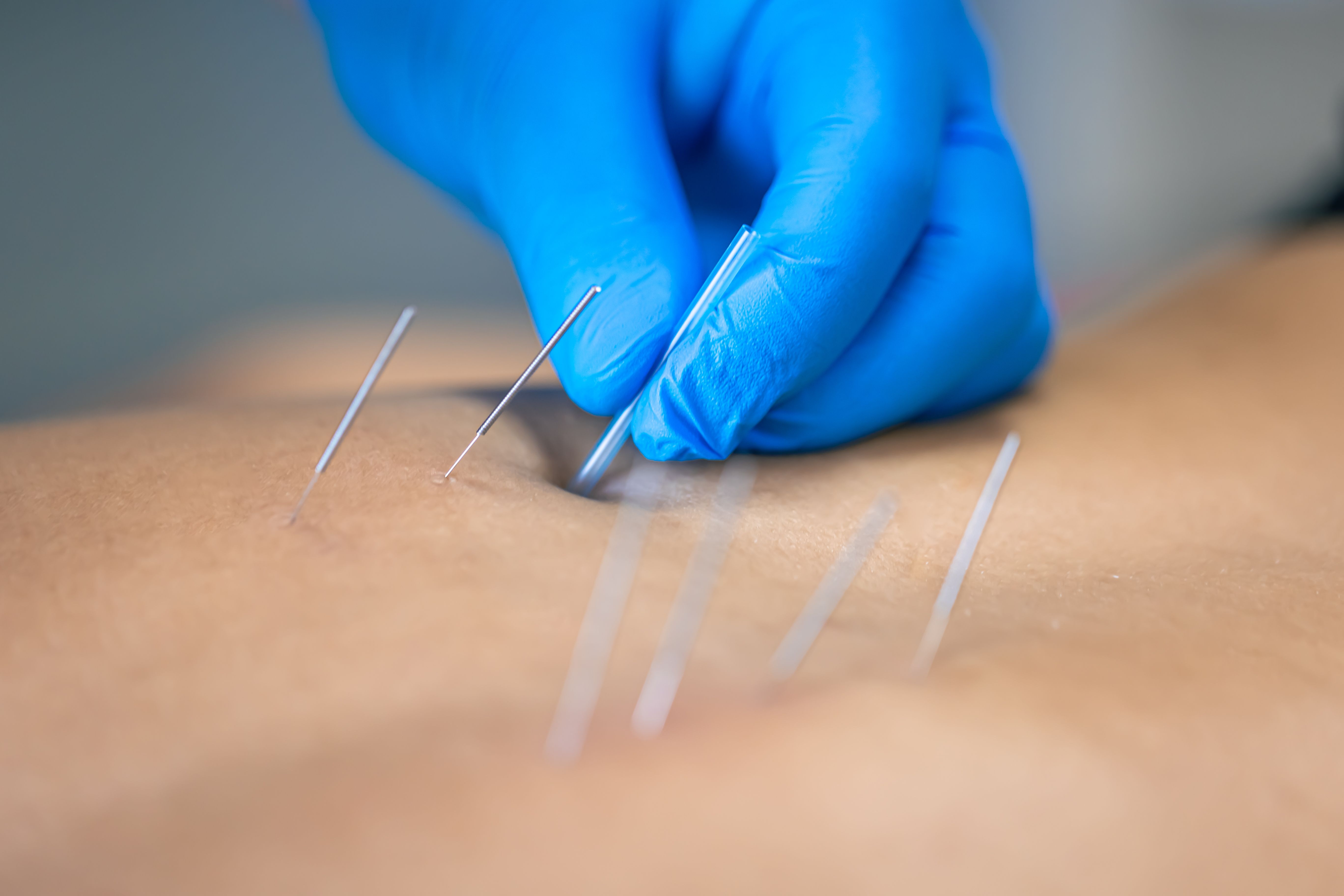 dry needling therapy