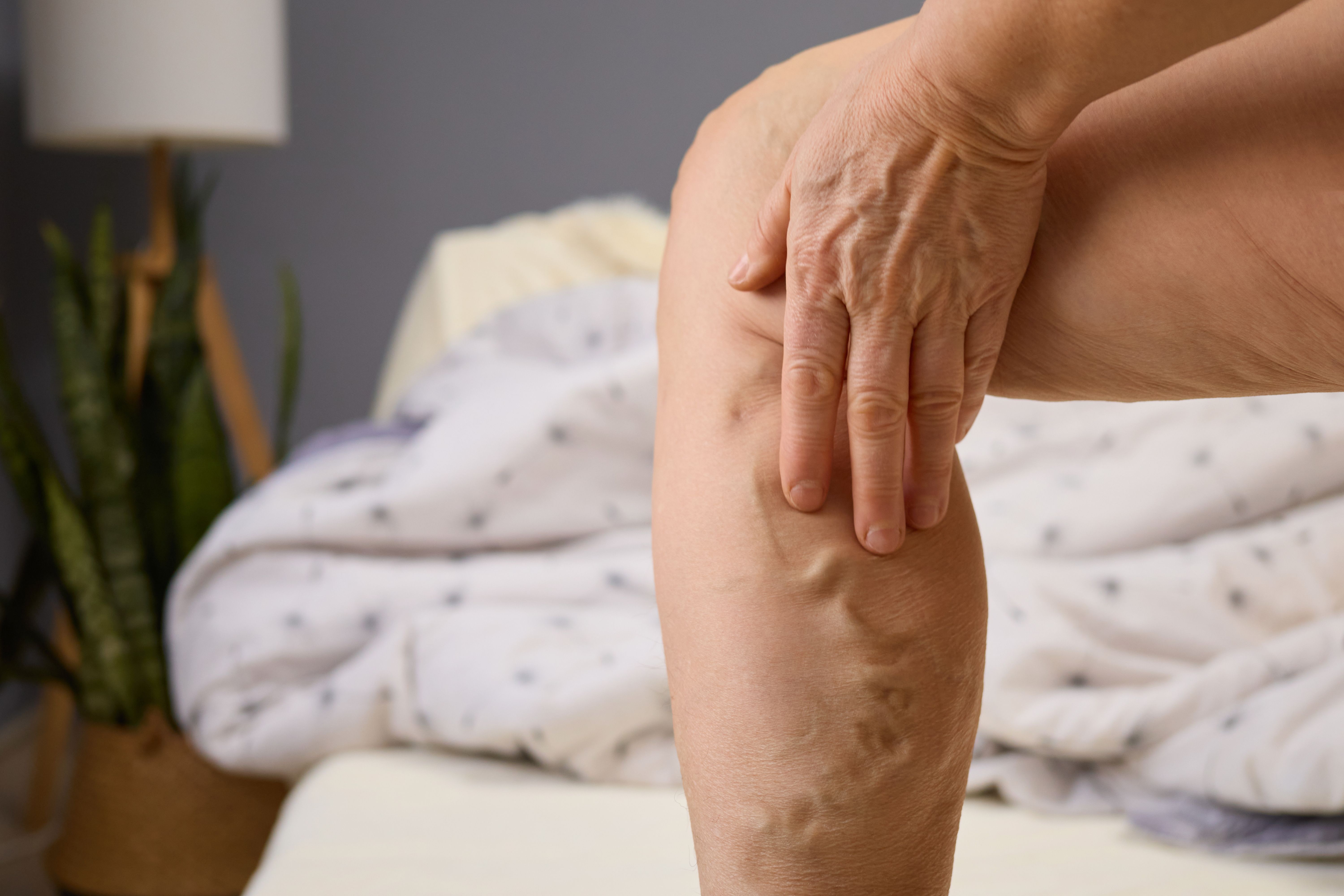 varicose veins