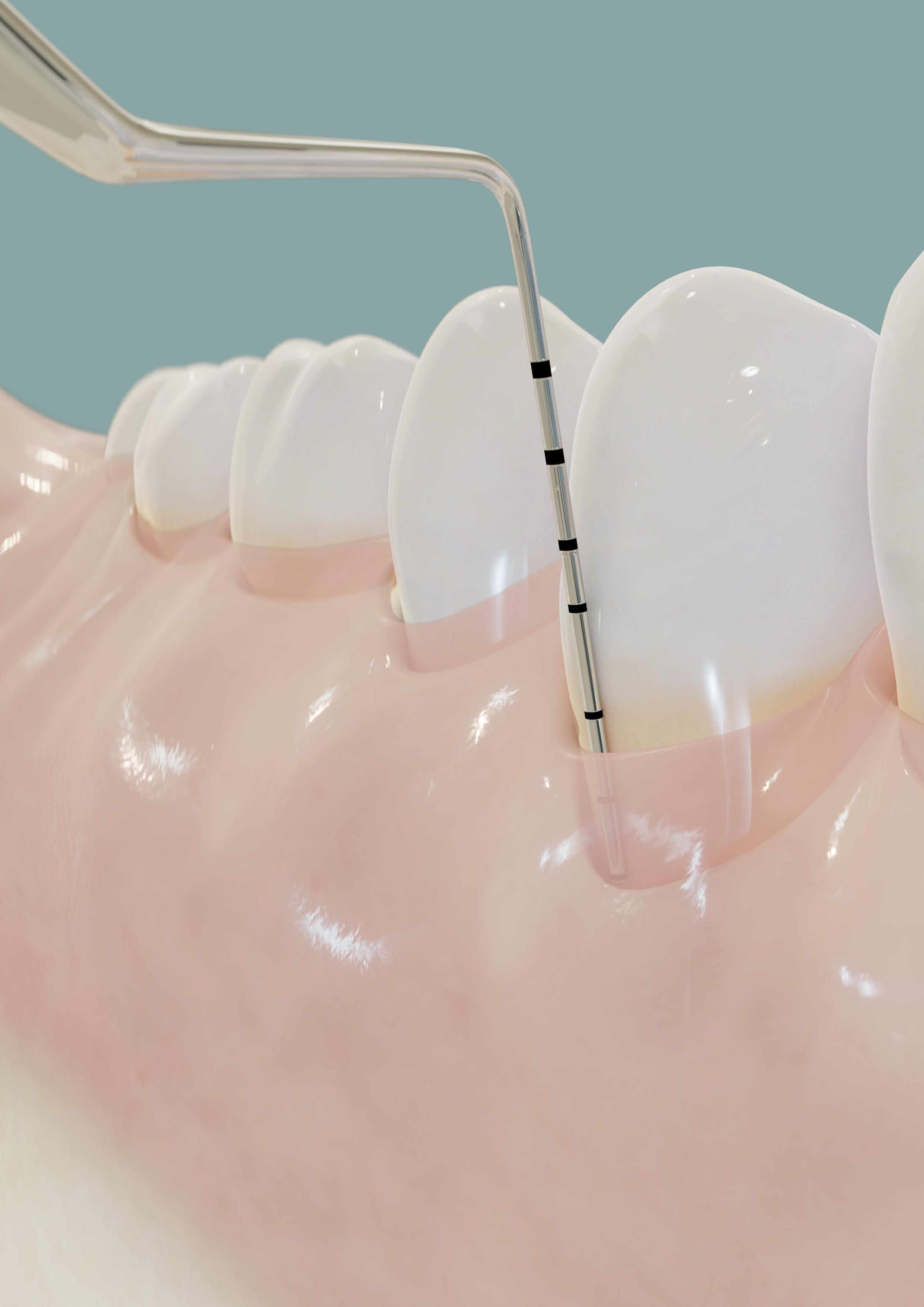 periodontal examination