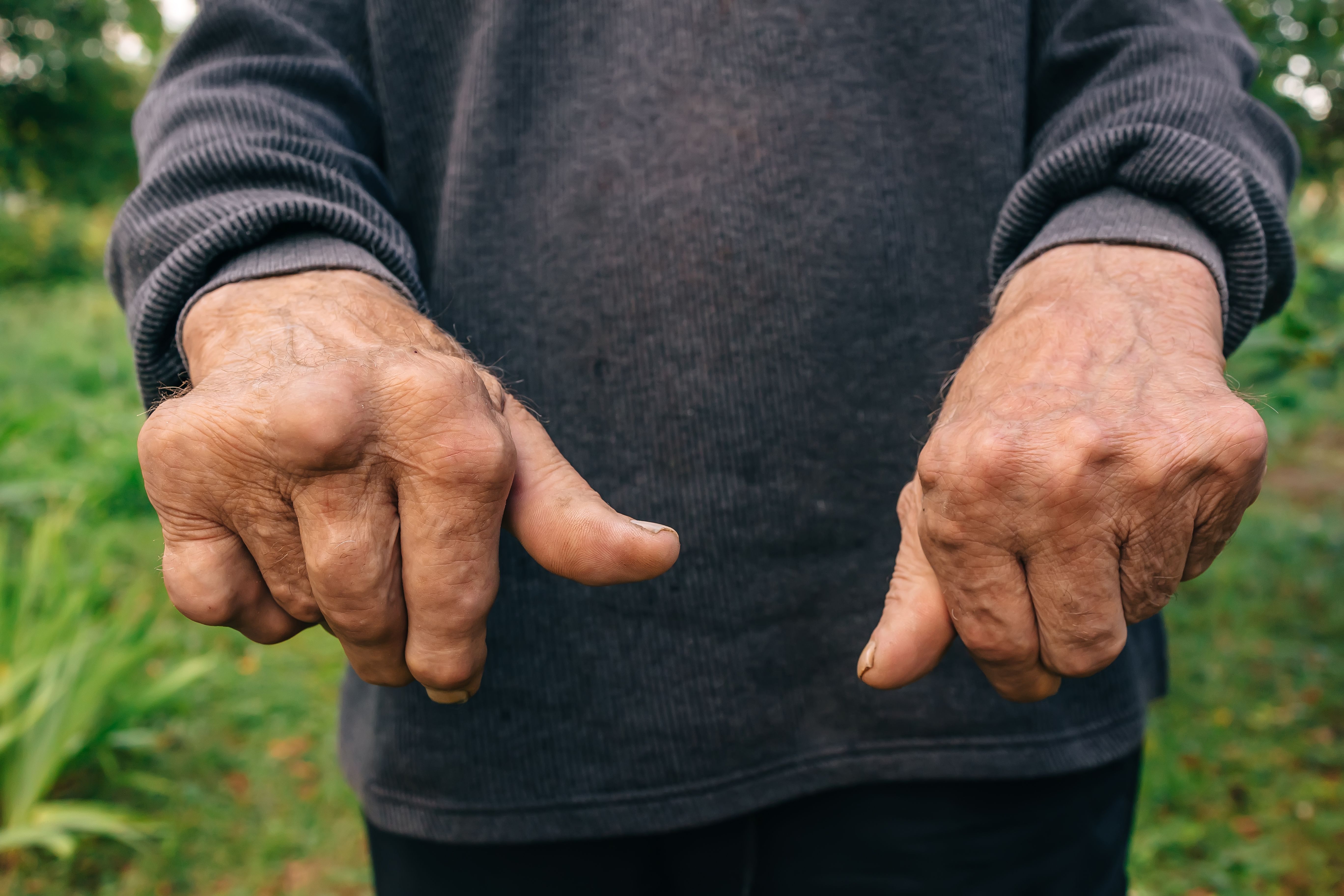 Hands of elder man. Concept of rheumatoid arthritis, osteoarthritis, or joint pain. Hand weakness. Hands of elder man. Concept of rheumatoid arthritis, osteoarthritis, or joint pain. Hand weakness.