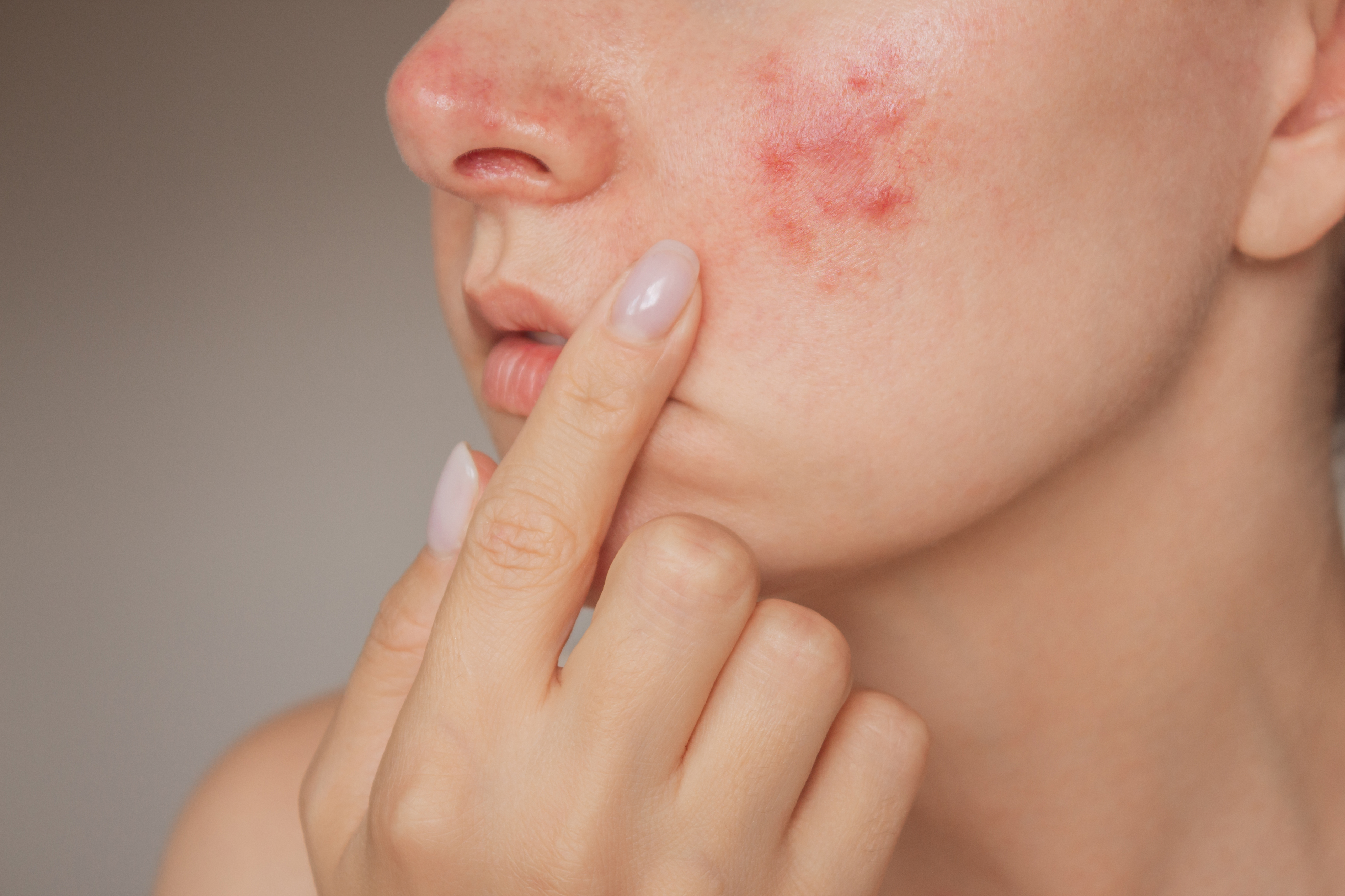 woman suffering from the skin chronic disease rosacea on her face in the acute stage. Pink acne.