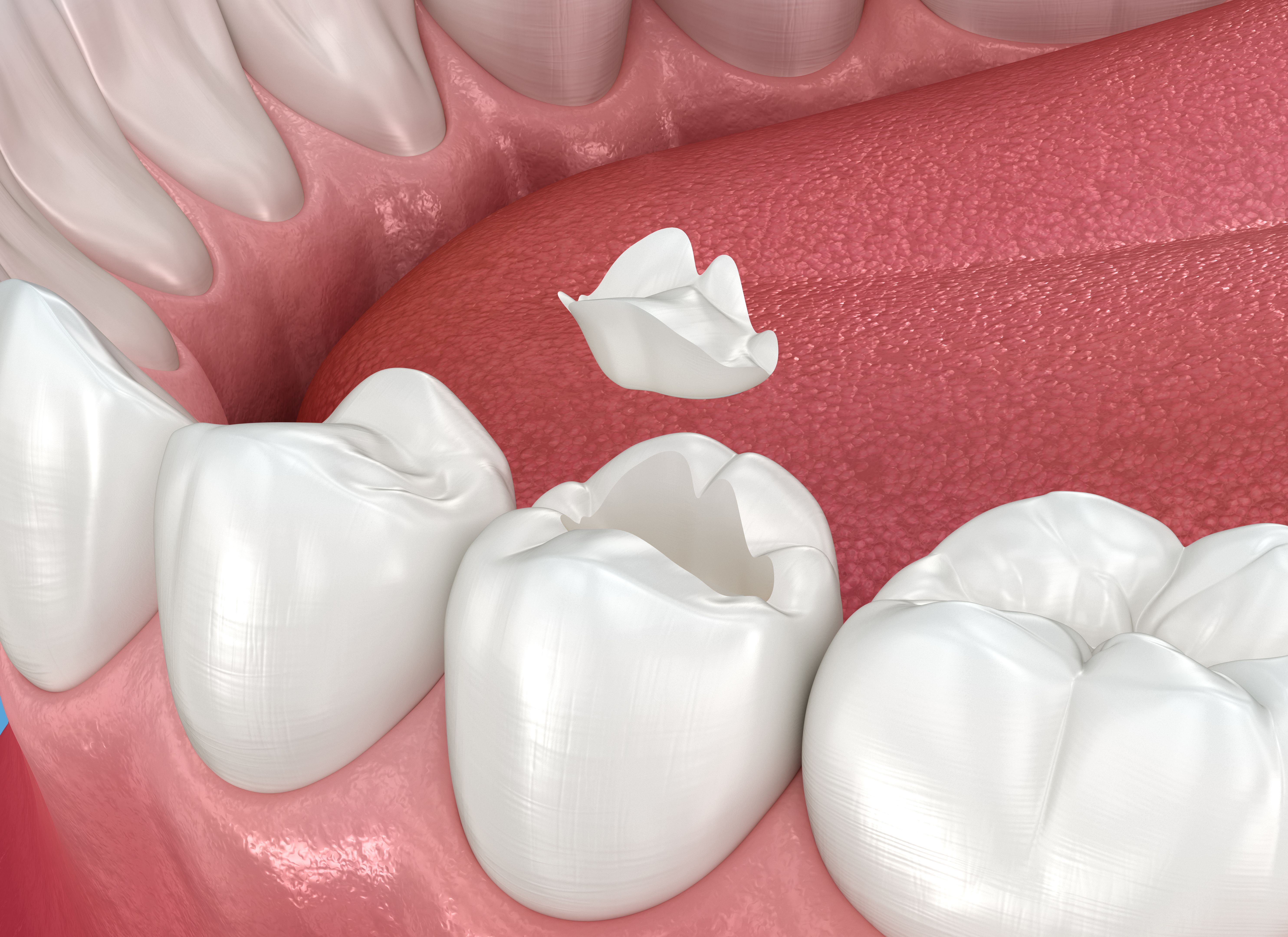 ceramic dental