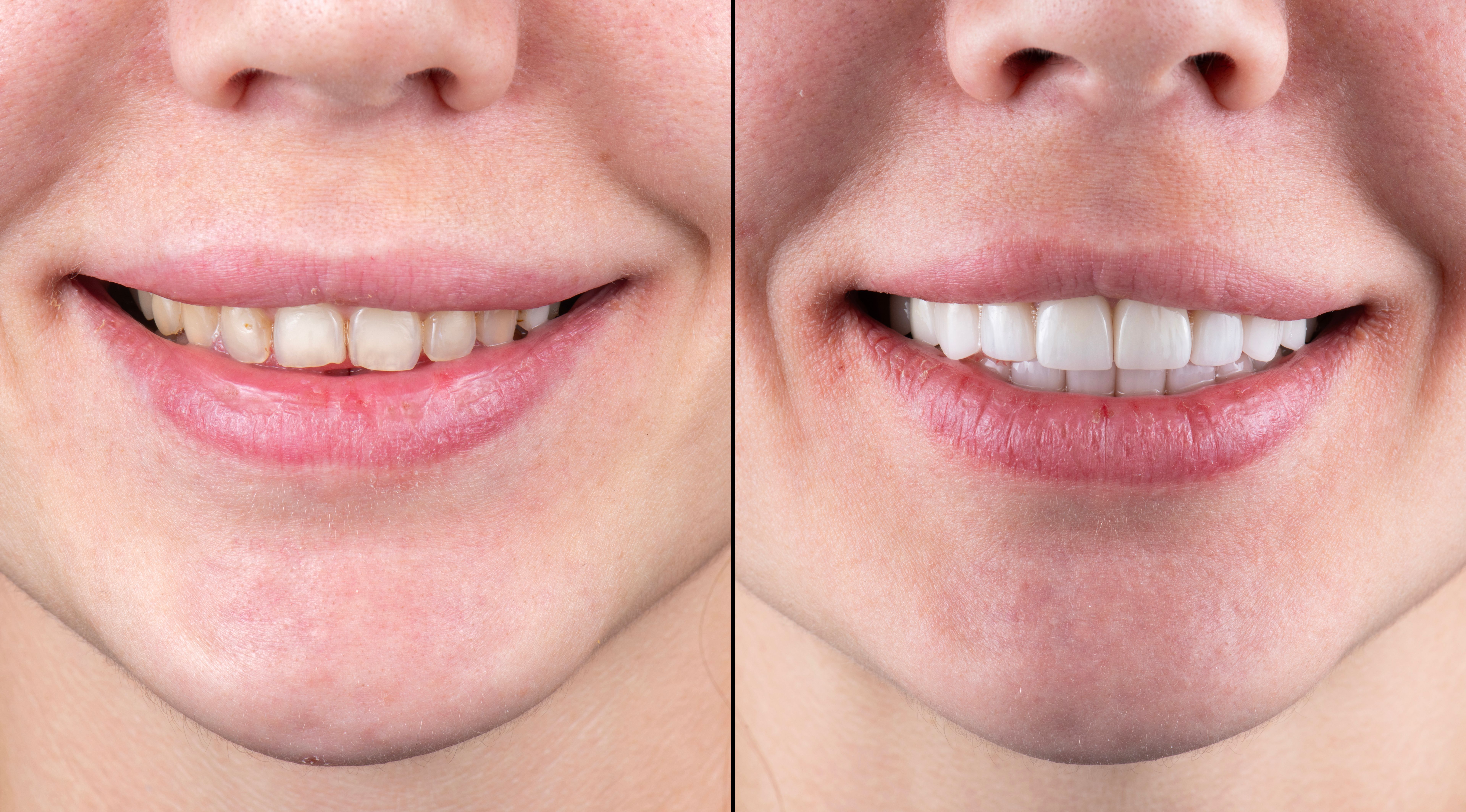 before and after teeth