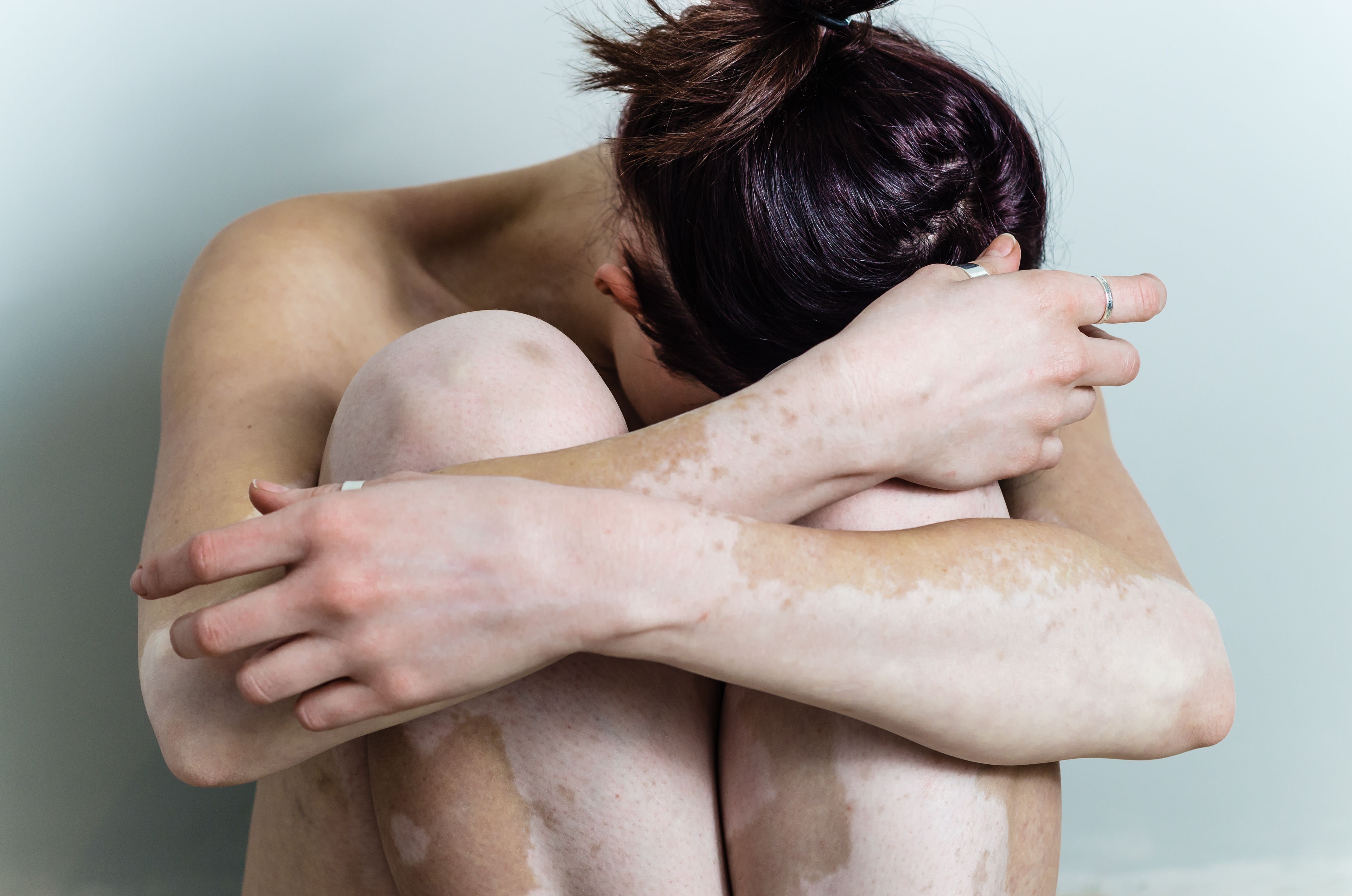 vitiligo affected young woman disappointed with head down