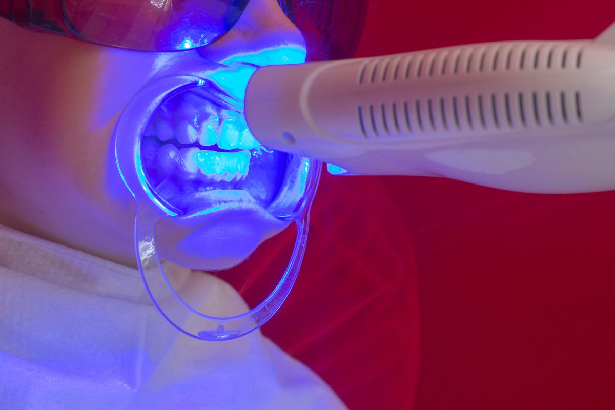 teeth whitening procedure ultraviolet lamp whiten teeth girl mouth extender